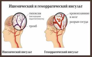 Ишемический инсульт при беременности: чем опасен, как распознать и предупредить