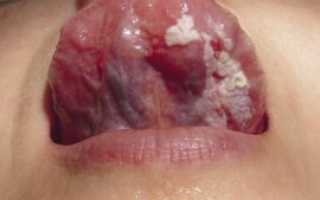 Лейкоплакия слизистой оболочки полости рта и языка: формы, причины, симптомы, лечение