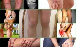 Коксартроз коленного сустава — что это такое, чем и как его лечить?