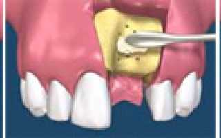 Наращивание костной ткани перед имплантацией зубов: суть процедуры, методы, этапы, стоимость