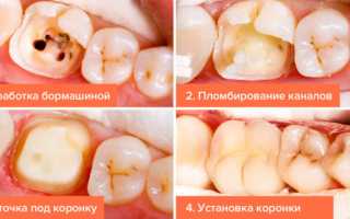 Как лечить больные зубы в домашних условиях и как купировать острую зубную боль