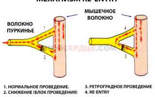 Все про желудочковую экстрасистолию: симптомы, лечение, последствия