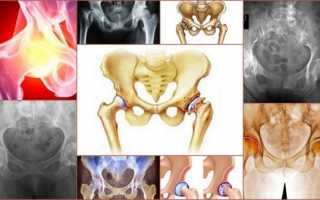 Симптомы и лечение деформирующего остеоартроза тазобедренного сустава