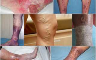 Симптоматика и лечение трофических язв на ногах при варикозе