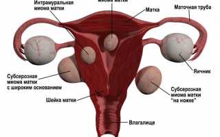 Лапароскопия при миоме матки — ход операции, восстановление и возможные осложнения