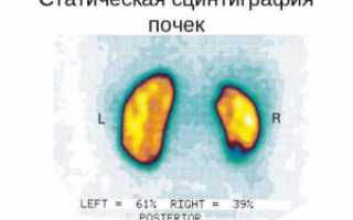 Сцинтиграфия — самый информативный метод исследования почек