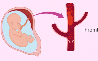 Тромбоз плаценты на ранних сроках: почему возникает, чем опасен и как избежать