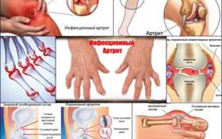 Симптомы и лечение инфекционного артрита