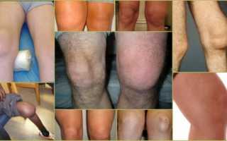 Синовит коленного сустава — что это такое и как его лечить?