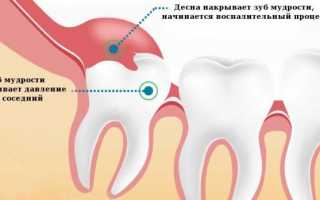 Воспалилась и опухла десна около зуба мудрости: причины, симптомы, лечение в клинике и домашних условиях