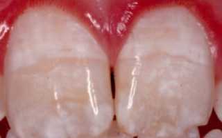 Зубная паста с фтором: польза и вред, влияние на зубы