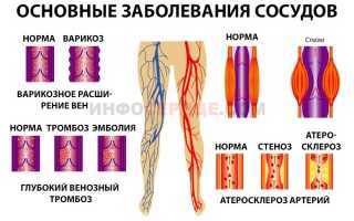 Как проводится профилактика возникновения тромбов в сосудах (тромбоза)?