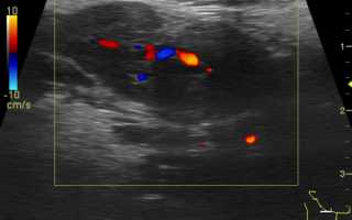 Что покажет УЗИ мягких тканей шейного отдела и как проводится: показания, подготовка, расшифровка