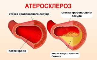 Чем опасен атеросклероз — какие последствия и осложнения?