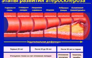 Что такое стенозирующий атеросклероз и как его лечить?