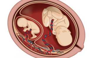 Фето фетальный синдром — что за опасность для беременных
