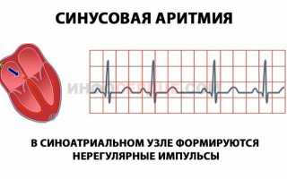 Что такое миграция водителя ритма и когда это опасно?