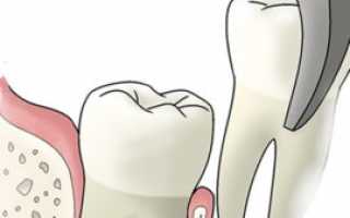 Удаление зуба мудрости: показания к операции, процедура удаления