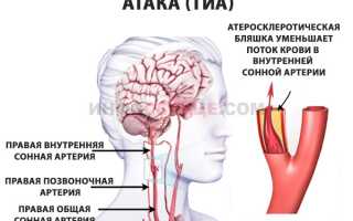 Особенности и опасность транзиторной ишемической атаки (ТИА)