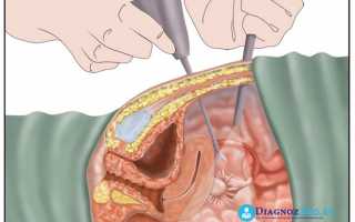 Лапароскопия – это точный диагноз, щадящее оперативное вмешательство и быстрое восстановление