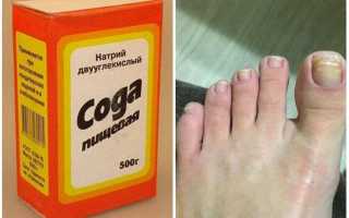 Сода против грибка ногтей на ногах — список самых эффективных средств