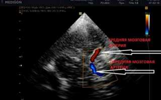 Что показывает УЗИ сосудов головного мозга (ТКДГ), как его делают и когда назначают