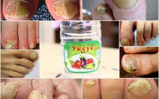 Народные рецепты лечения уксусом грибка ногтей на ногах