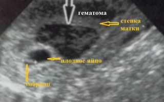 Чем опасна гематома в матке при беременности