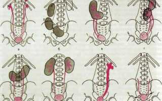 Формы и виды дистопии почки: симптомы, диагностика и лечение