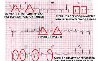 В чем особенность трансмурального инфаркта миокарда?