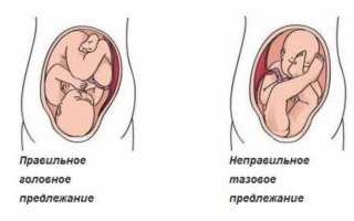 Как родить при аномальном предлежании плода