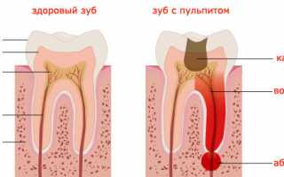 Повышенная чувствительность зубов: причины, лечение в домашних условиях
