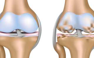 Что такое артроз коленного сустава и как его лечить?