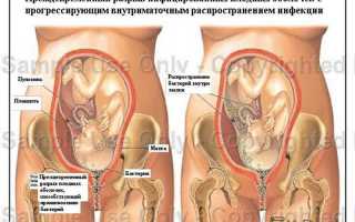 Преждевременный разрыв плодных оболочек: причины, симптомы, риски