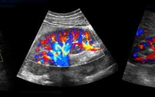 Для чего проводят УЗИ (УЗГД) сосудов почек, что оно показывает и как расшифровать результаты