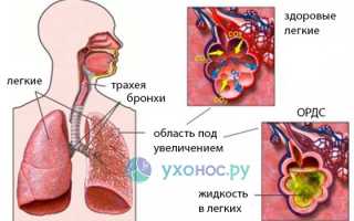 Респираторный дистресс-синдром (РДС): причины и как развивается, симптоматика, лечение