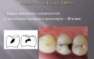 Классификация кариеса зубов по Блэку и по системе ВОЗ, особенности препарирования кариозных полостей