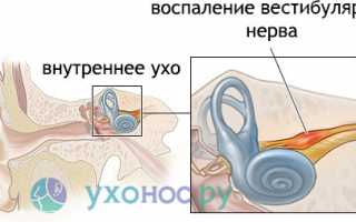 Неврит слухового нерва: причины, признаки, как лечить