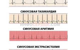 Что делать при синусовой аритмии у ребенка или подростка?