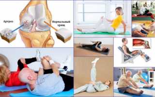 Лечебная гимнастика при артрозе коленного сустава —  комплекс упражнений