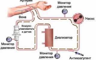 Методика проведения диализа почек: возможные осложнения