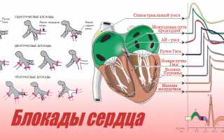 Что такое блокада сердца, какие у нее степени, методы лечения