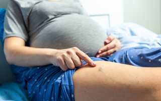 Чем опасен тромбофлебит при беременности, можно ли рожать и как лечить патологию у будущих мам?