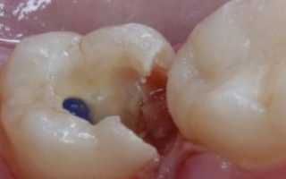 Мышьяк в зубе: для чего ставят, сколько можно держать взрослым и детям, как действует, возможные осложнения