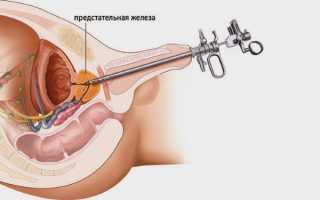Как проводиться УЗИ простаты у мужчин, что показывает в норме и при болезни