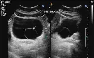 Причины уретероцеле: симптомы, лечение и осложнения