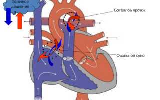 Чем грозит открытый артериальный (Боталлов) проток у ребенка?