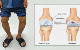 Деформирующий артроз коленного сустава — что это такое, чем и как его лечить?