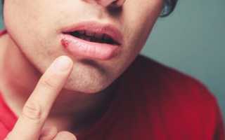 Какими таблетками и лекарственными препаратами можно вылечить герпес на губах