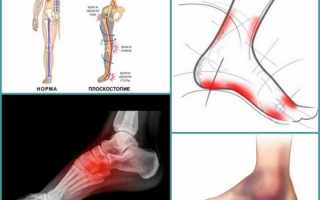 Что и как болит при плоскостопии?